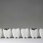 HOW DOES A TOOTH DECAY?