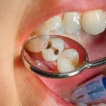 WHAT IS DENTAL CARIES? TREATMENTS, SIGNS, AND SYMPTOMS