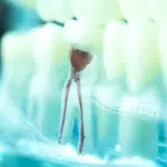 WHAT HAPPENS DURING A ROOT CANAL?—PART III