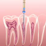 WHAT HAPPENS DURING A ROOT CANAL?—PART II