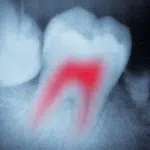 WHAT HAPPENS DURING A ROOT CANAL?–PART V