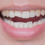 CHIPPED, CRACKED, CROOKED TEETH