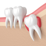 WISDOM TEETH PROBLEMS, IMPACTED TEETH, TOO MANY TEETH