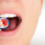 WHAT TO WATCH FOR WITH GUM DISEASE