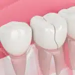 CRACKED TEETH