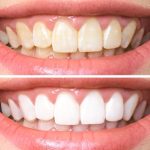 NATURAL CHANGES IN THE MOUTH